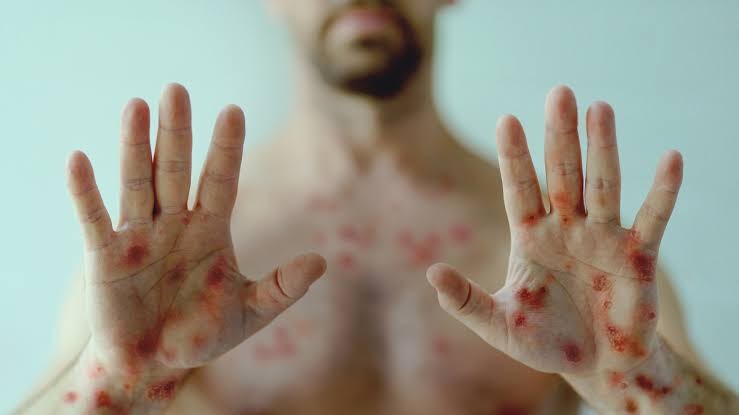 Saúde descarta caso suspeito de monkeypox no Acre e notifica outro