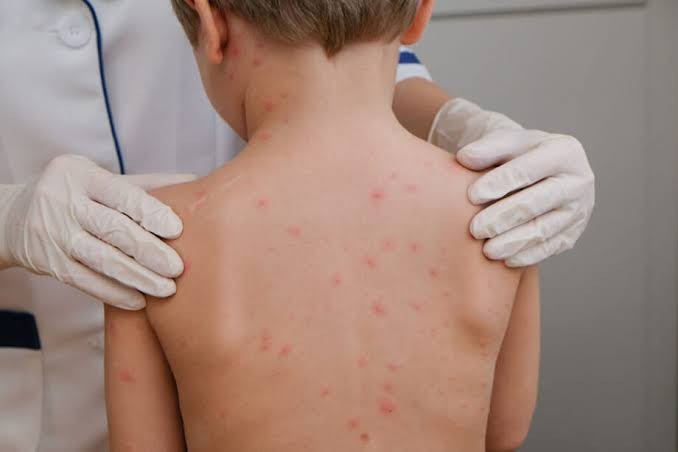 Saúde alerta para aumento de casos de meningite no Acre