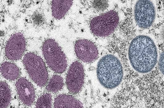 Saúde notifica caso suspeito de monkeypox no Acre