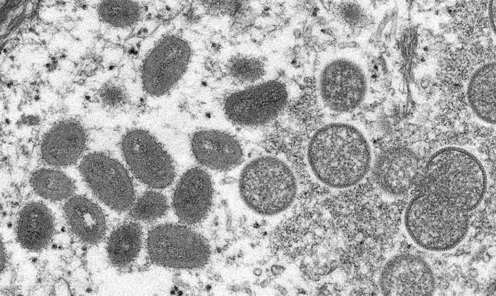 Saúde notifica mais dois casos suspeitos de monkeypox no Acre